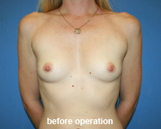 plastic-surgery-breast-augmentation